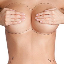 Breast Augmentation surgery
