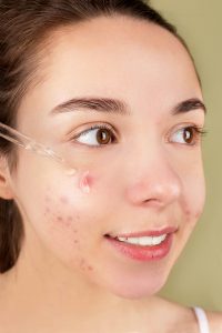 Young woman with acne marks applying serum showing need for medical-grade skin treatments